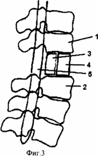 СПОСОБ ХИРУРГИЧЕСКОГО ЛЕЧЕНИЯ ПОСЛЕДСТВИЙ ПЕРЕЛОМОВ ПОЗВОНОЧНИКА