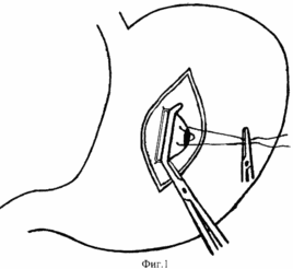СПОСОБ ХИРУРГИЧЕСКОГО ЛЕЧЕНИЯ ОСЛОЖНЕННЫХ ЯЗВ ЗАДНЕЙ СТЕНКИ ЖЕЛУДКА